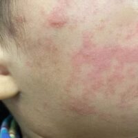 measles on child's cheek