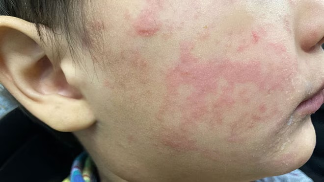 measles on child's cheek