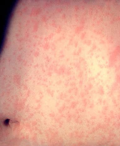 people_measles9