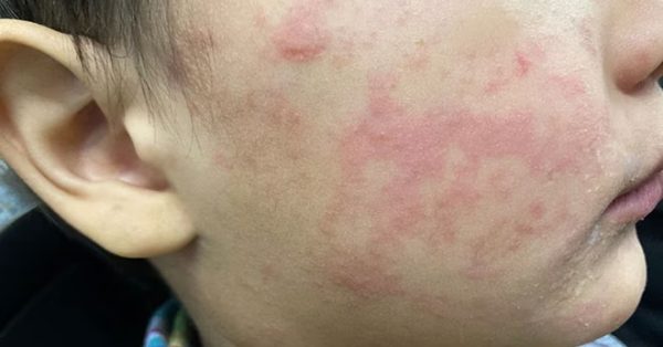 measles on child's cheek